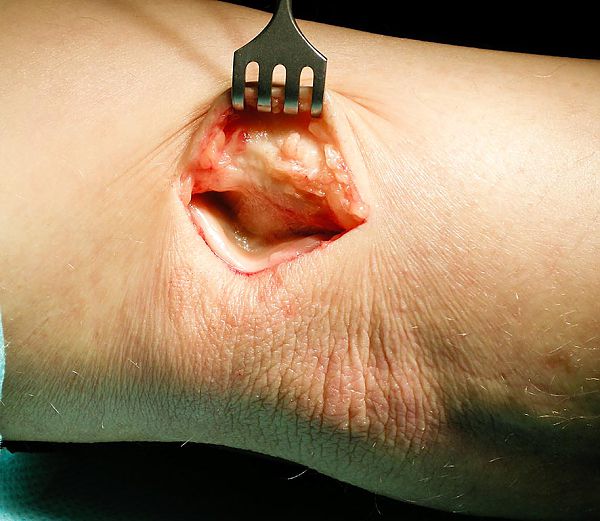 sulcus_ulnaris_syndrom.jpg